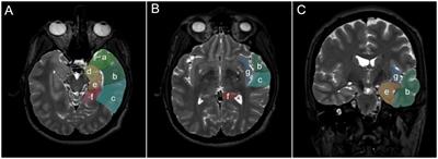 Anatomy-guided resections for paralimbic tumors in the temporo-insular region: combining tumor and epilepsy surgery concepts